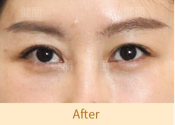 真實醫療案例 1 after
