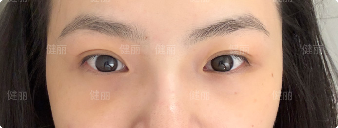 術後第3天